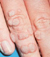 Warze am Finger